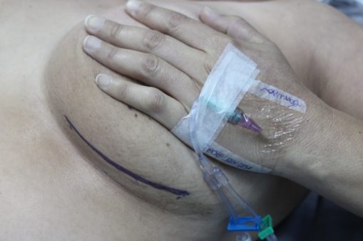 16 Preparação para cirurgia de mama